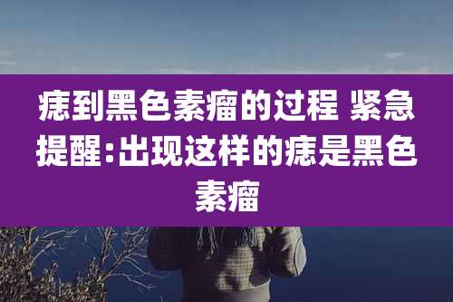 痣到黑色素瘤的过程 紧急提醒:出现这样的痣是黑色素瘤