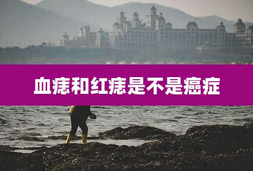血痣和红痣是不是癌症